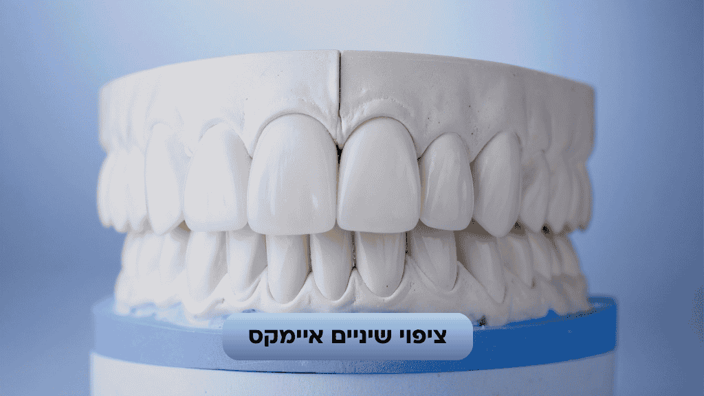 ציפוי שיניים איימקס
